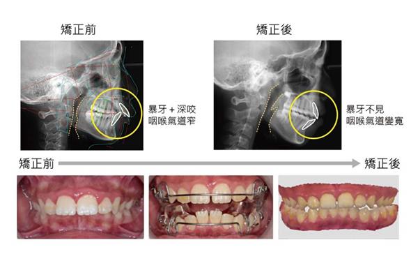 《矯正可以不拔牙》第42頁 .jpg