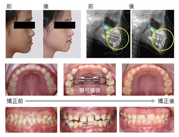 《矯正可以不拔牙》第43頁 .jpg